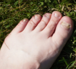 פטרת ציפורניים: כך תיפטרו ממנה-תמונה